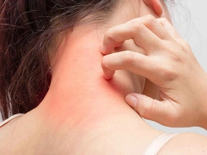 Eczema: Common Symptoms, Causes, and Natural Remedies