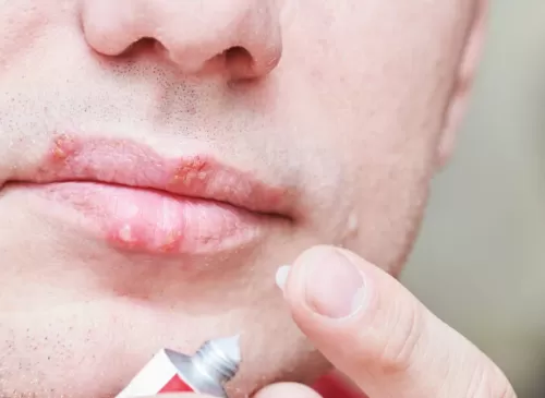 How to Avoid Cold Sores: A Comprehensive Guide