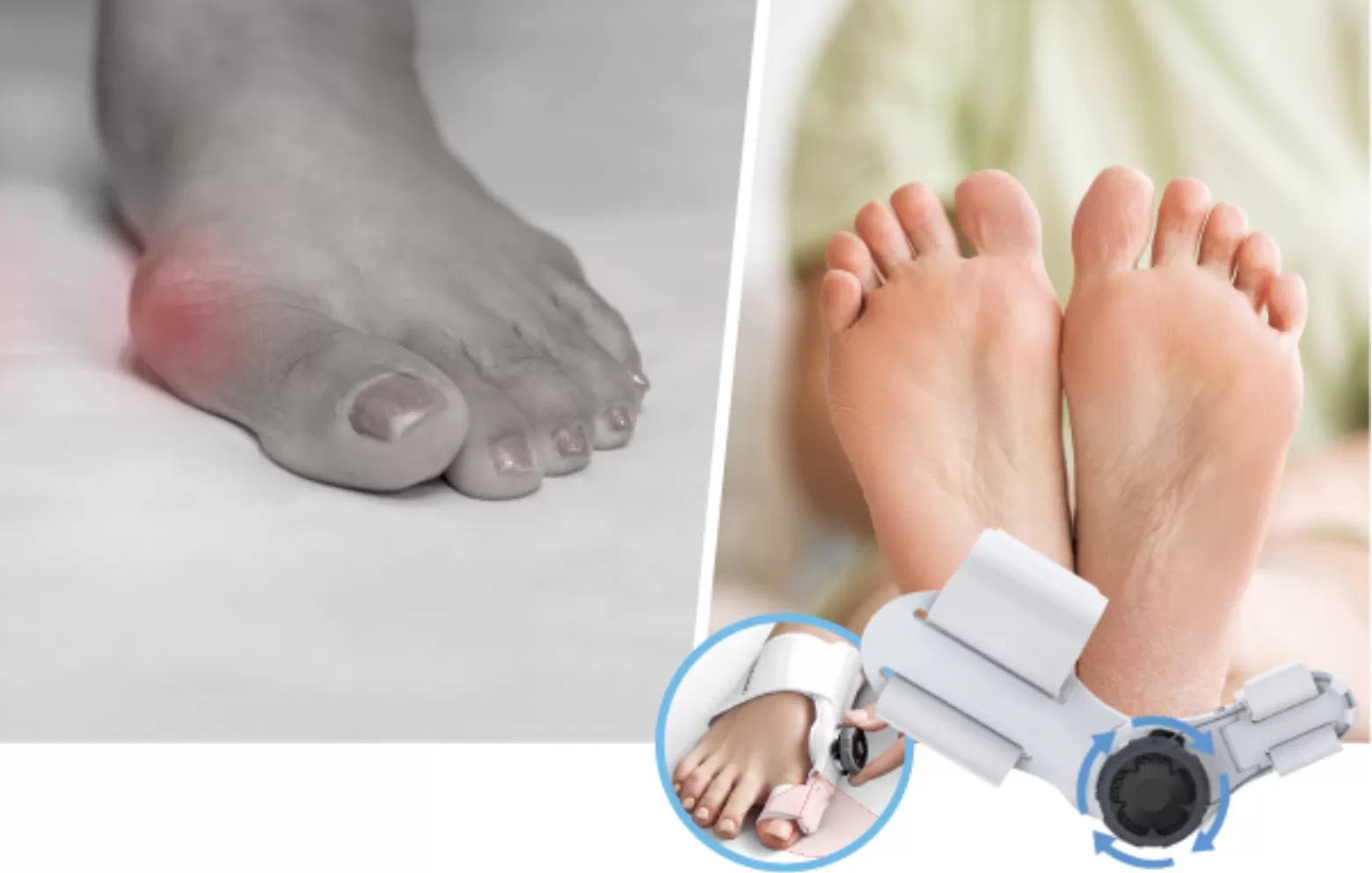 This is the bunion corrector that really works!