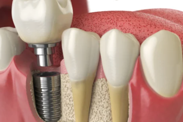 Something you must know about dental implant