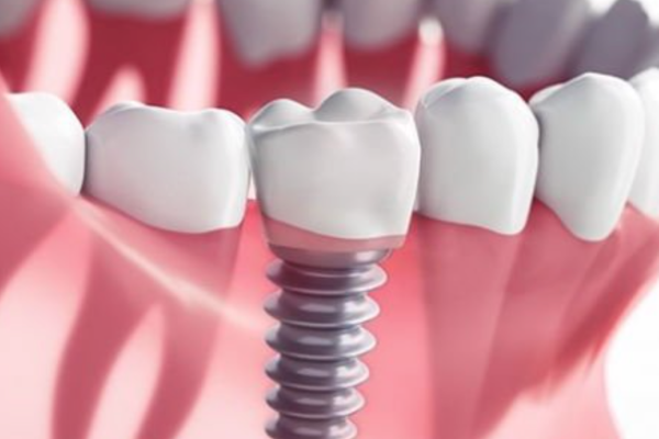 Special Offers on Dental Implants: Restore Your Smile at a Discount