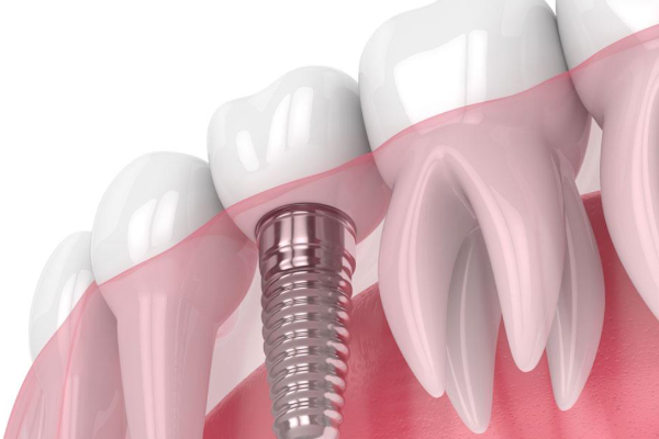 Dental Implantation: Your "Smiling" New Partner