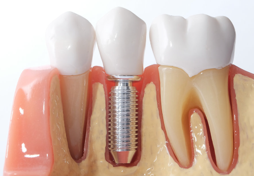 Pricing Standards for Dental Implant Clinics