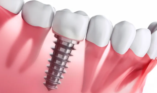 Secrets Revealed: Seniors, Learn How to Get Dental Implants for Free