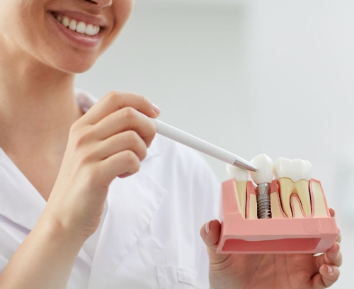 Everything You Need to Know About Dental Implants Clinics