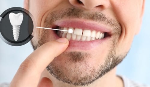 Understanding-Dental-Implants:-A-Long-Term-Solution-for-Missing-Teeth