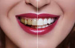 Bright Smiles Ahead: Unlocking the Secrets of Teeth Whitening