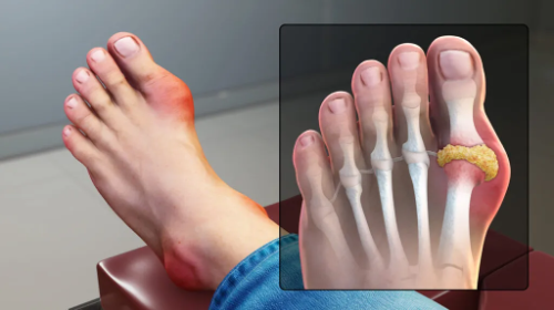 Gout Symptoms: Recognizing the Signs of a Painful Condition