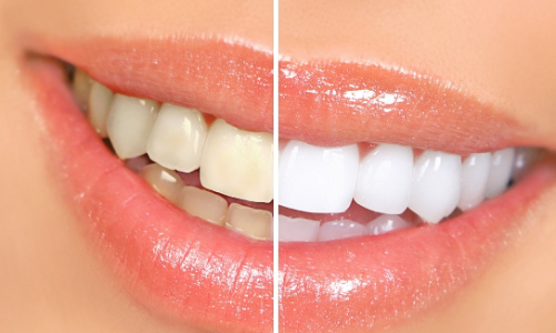 Discover the Best Cosmetic Dentistry Options for Your Perfect Smile