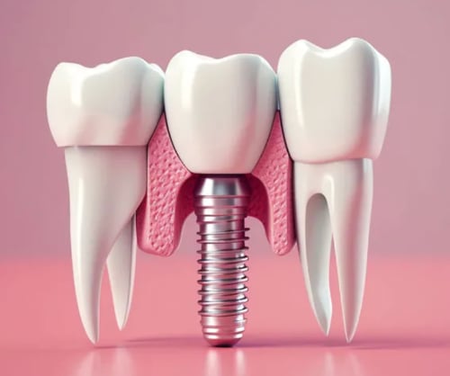 Dental Implants: The Perfect Solution for a Confident Smile