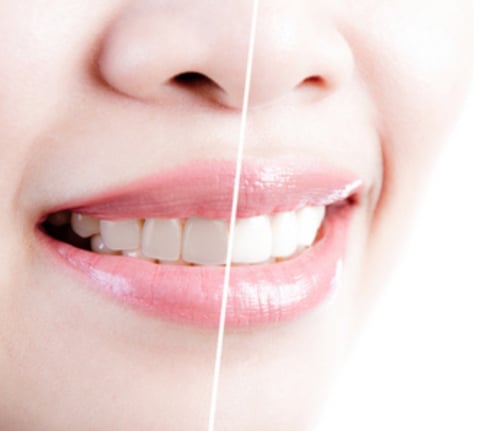 Bright Smile, Instant Spotlight! Try Teeth Whitening and Unleash a Whole New Charm