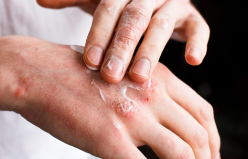 Psoriasis Treatment for Older Adults in the US