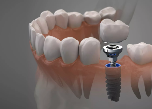 Dental Implants: The Complete Guide to Tooth Replacement in 2024