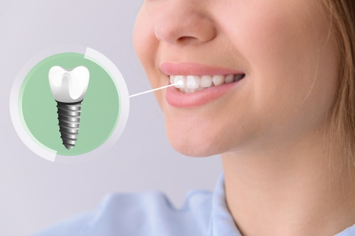 The Transformative Power of Dental Implants