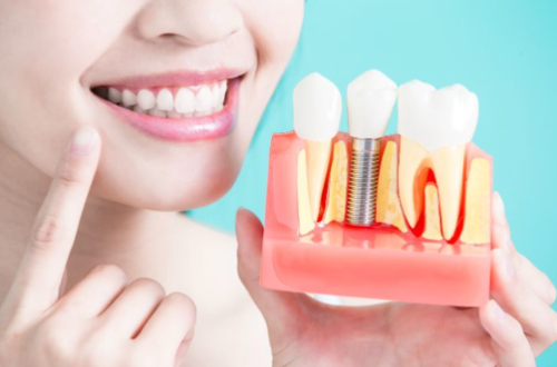 Transform Your Smile with Affordable Dental Implants