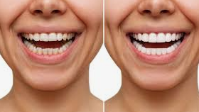 The Journey to Teeth Whitening Bliss