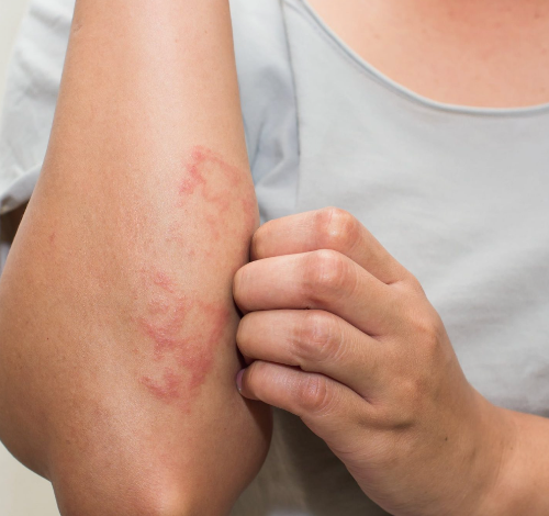 Effective Solutions for Atopic Dermatitis