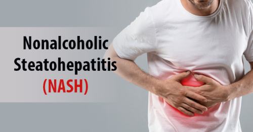 Comprehensive Guide to NASH: Understanding, Diagnosing, and Managing Non Alcoholic Steatohepatitis