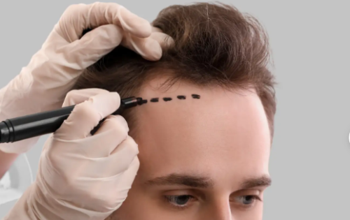 Everything You Need to Know About Hair Transplants: A Comprehensive Guide