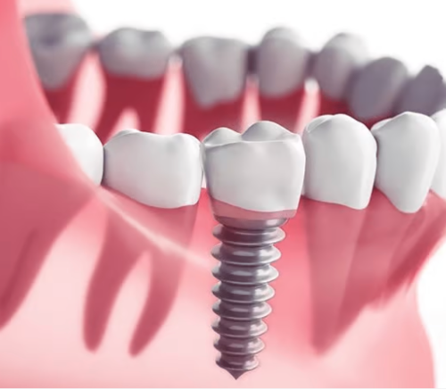 Exploring Discounts on Dental Implants in the US