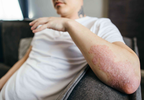 Understanding Plaque Psoriasis: Causes and Insights