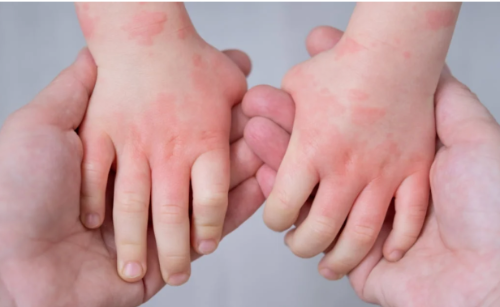 Understanding Eczema Signs: Recognizing the Symptoms