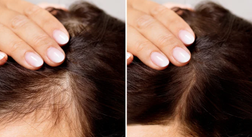 Effective Solutions for Hair Loss and Regrowth