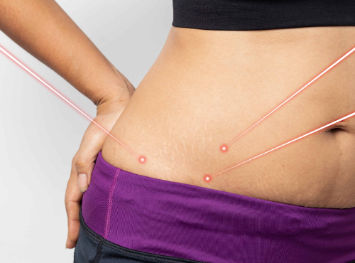 Laser-Fat-Removal:-A-Modern-Solution-to-Stubborn-Fat