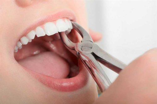 Understanding Tooth Extraction: Navigating the Path to Oral Health and Comfort